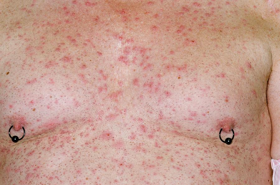 Folliculitis On The Chest Photograph by Dr P. Marazzi ...