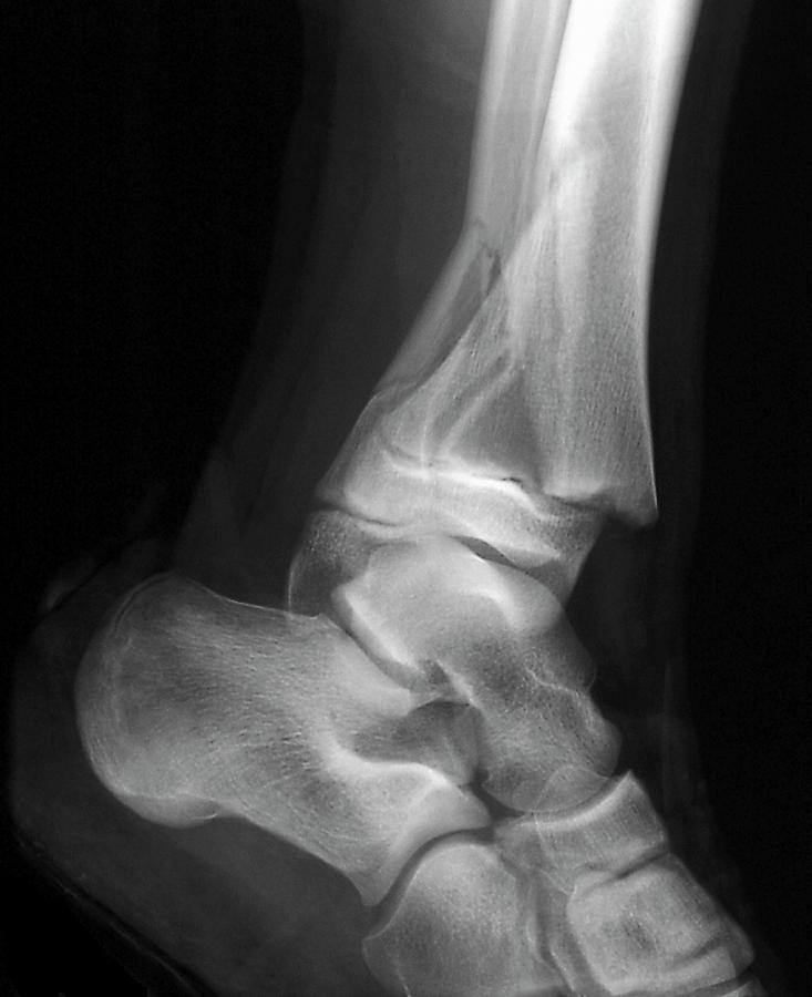 Black And White Photograph - Fractured Ankle #1 by Zephyr