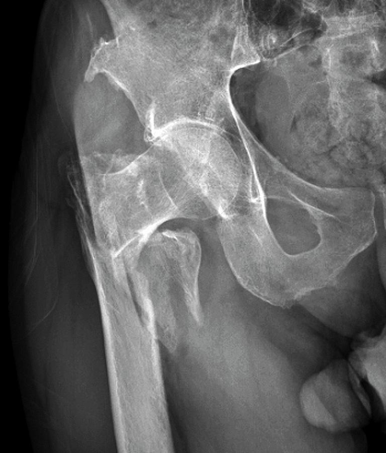 Fractured Hip #1 Photograph by Zephyr