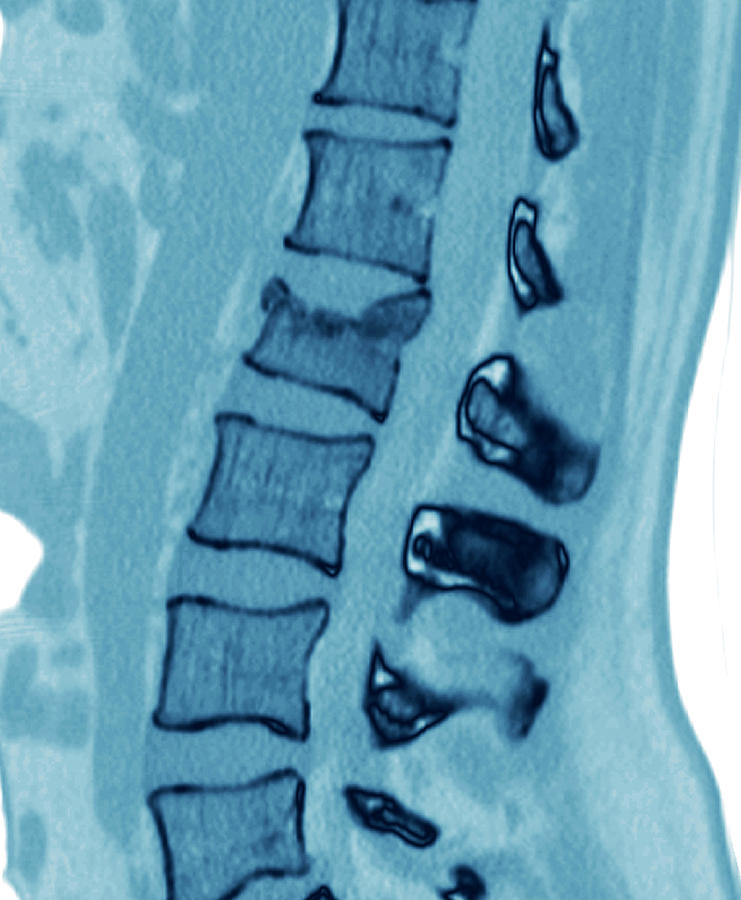 Fractured Spine Photograph by Zephyr/science Photo Library | Pixels