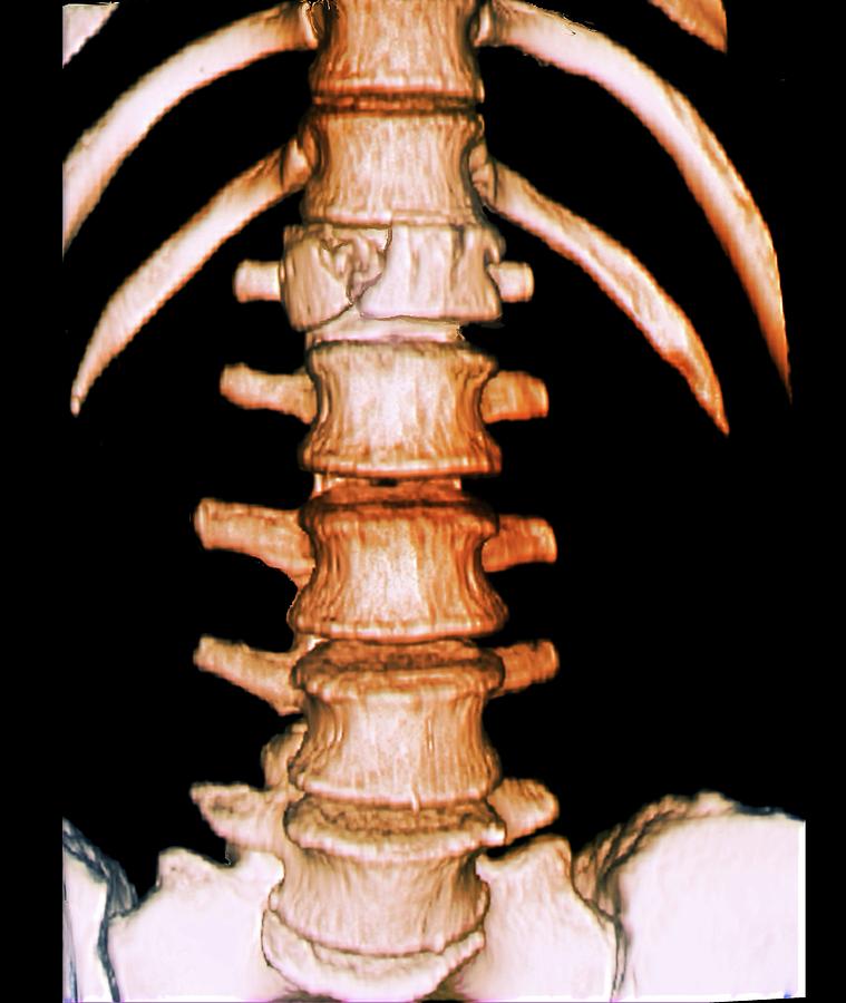 Fracture Photograph - Fractured Vertebra #1 by Zephyr/science Photo Library