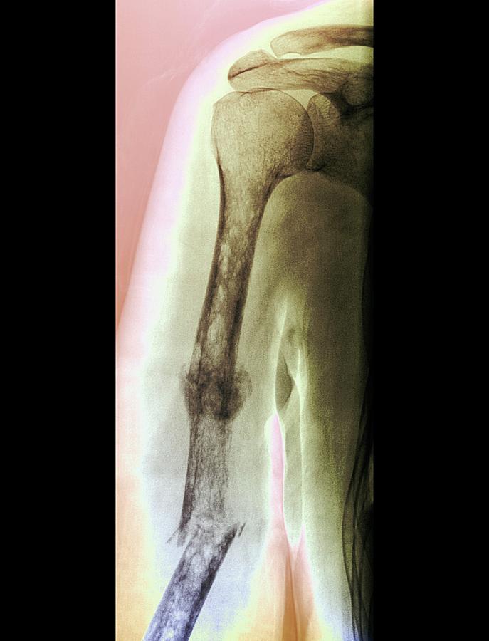 Fractures And Bone Cancer #1 Photograph by Zephyr/science Photo Library