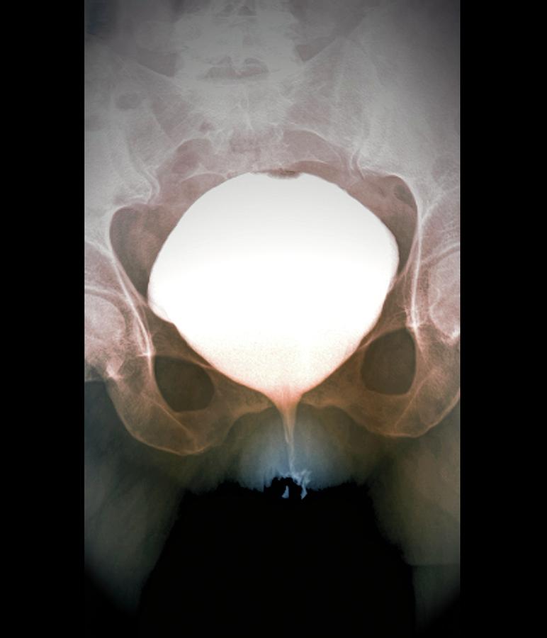 Full bladder video Full bladder video