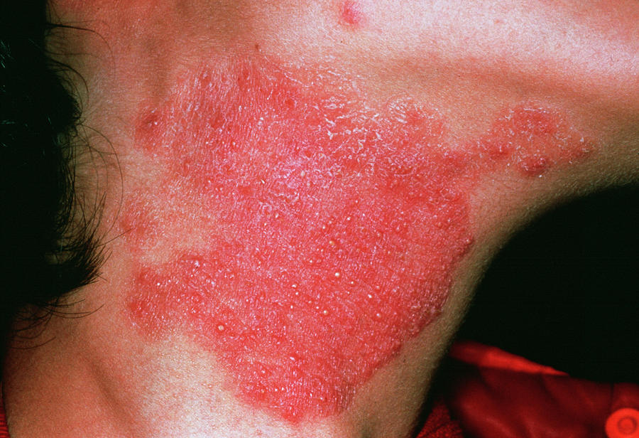 Fungal Skin Infection 1 Photograph By Cnriscience Photo Library Pixels