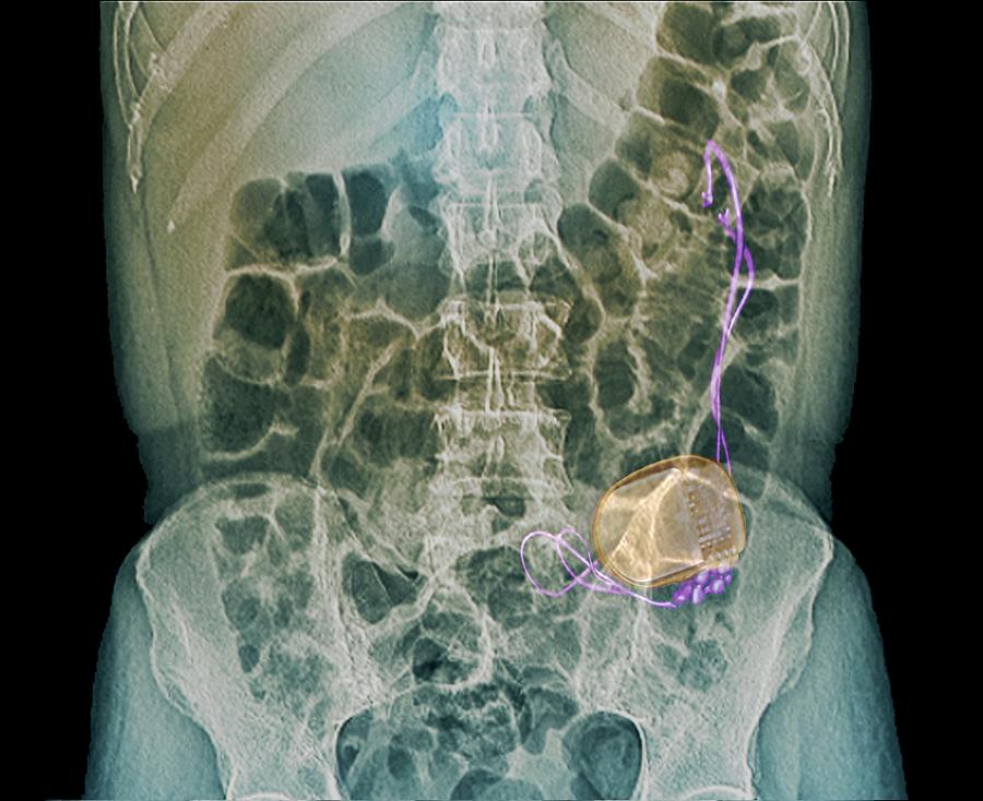 gastric stimulator