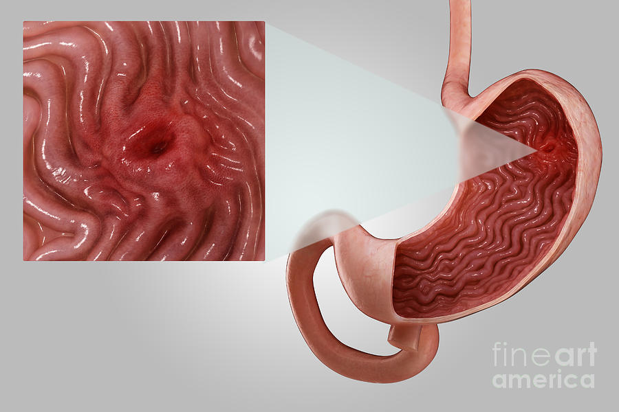 Gastric Ulcer #1 Photograph by Science Picture Co