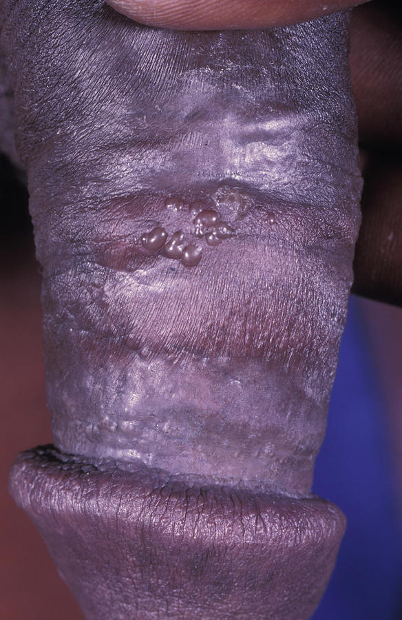 Herpes bilder genital Genital herpes