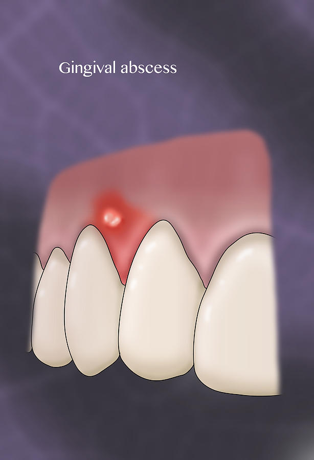 Gingival Abscess, Illustration #1 Photograph by Monica Schroeder
