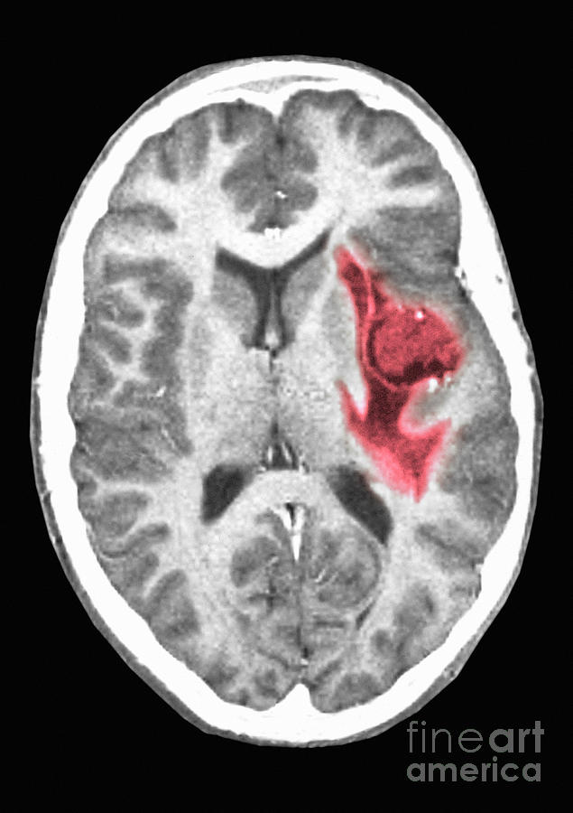 Glioma Brain Tumor #1 Photograph by Scott Camazine