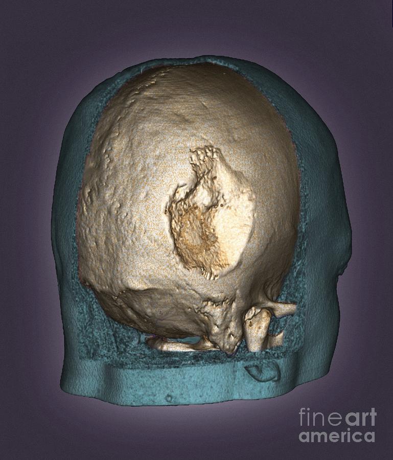 Gorham's Disease, 3d Ct Scan Photograph by Zephyr