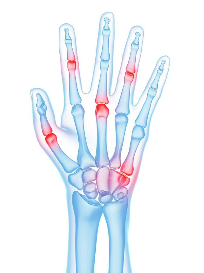 Hand Joint Pain Photograph by Sciepro/science Photo Library - Pixels