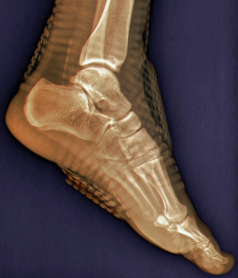 Xray Photograph - Healthy Ankle Joint #1 by Zephyr/science Photo Library
