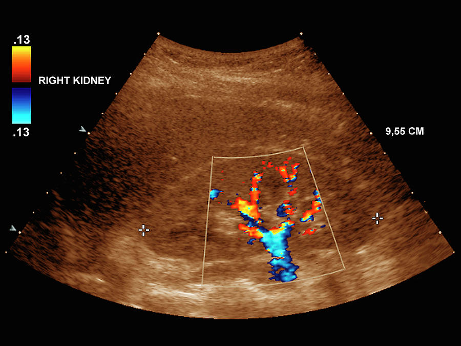 Healthy Kidney Photograph by Zephyr/science Photo Library | Pixels