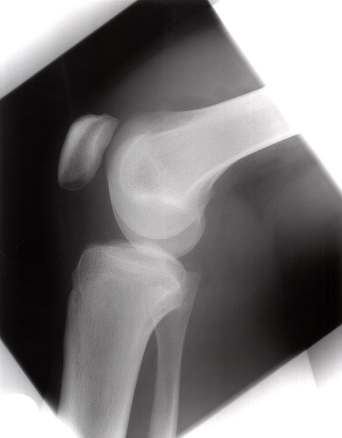 Healthy Knee #1 Photograph by Daniel Sambraus/science Photo Library