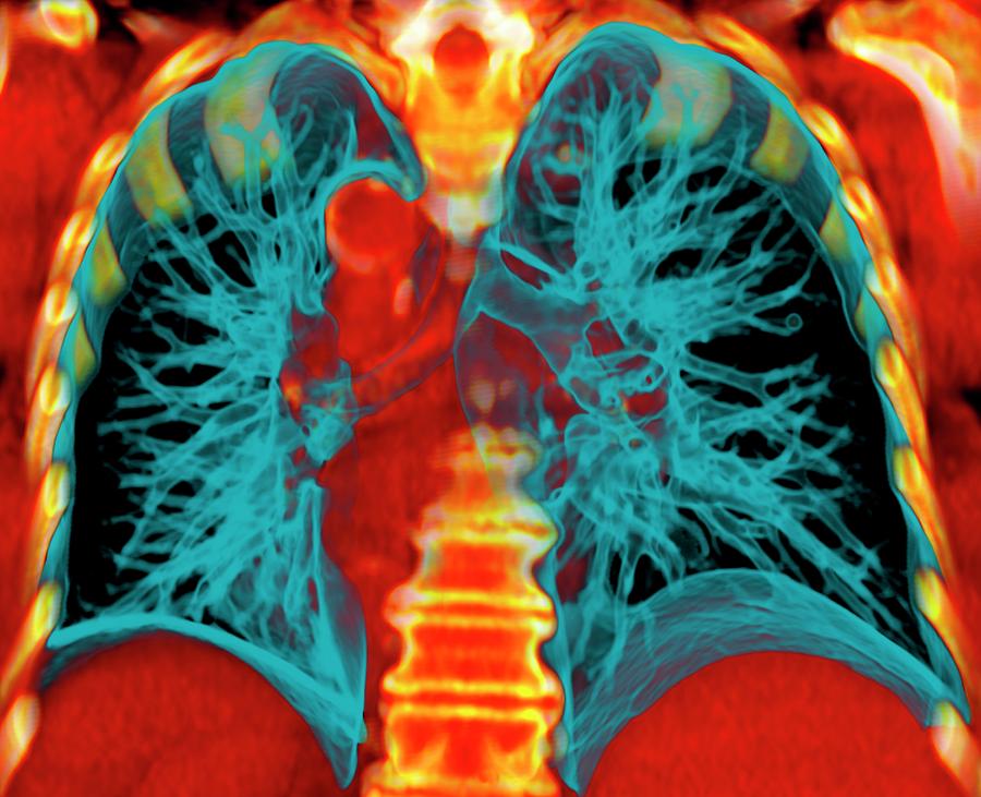 Healthy Lungs Photograph By Du Cane Medical Imaging Ltd - Fine Art America