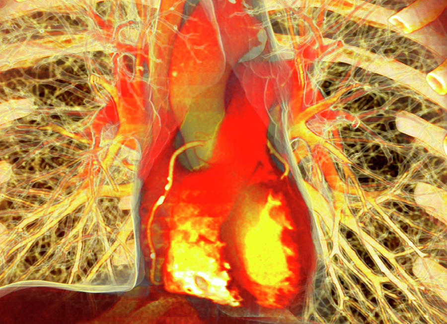 Lungs Photograph - Heart And Lungs #1 by Antoine Rosset/science Photo Library