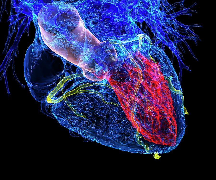 Heart In Coronary Artery Disease Photograph by K H Fung/science Photo ...