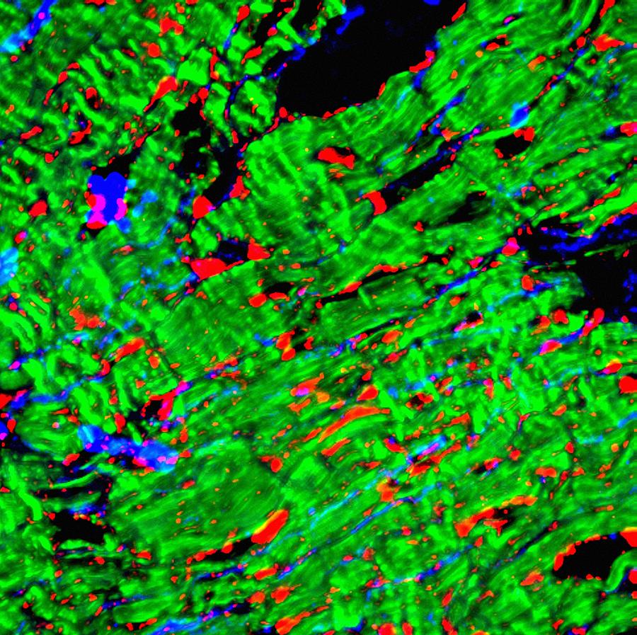 Heart Muscle After Cardiac Arrest Photograph by R. Bick, B. Poindexter ...