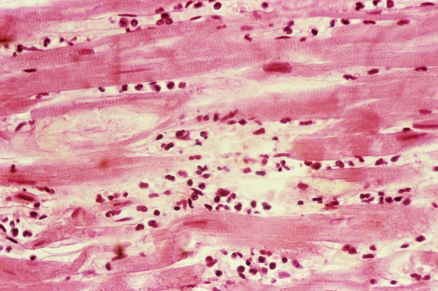 Light Micrograph Photograph - Heart Myxoedema In Hyperthyroidism #1 by Pr. R. Abelanet - Cnri