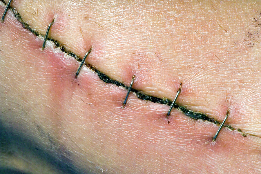 open heart surgery scar