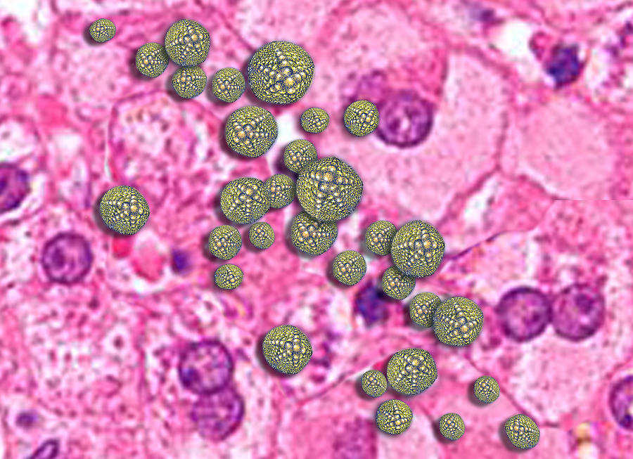 Hepatitis A Infecting Liver Tissue #1 Photograph by Chris Bjornberg