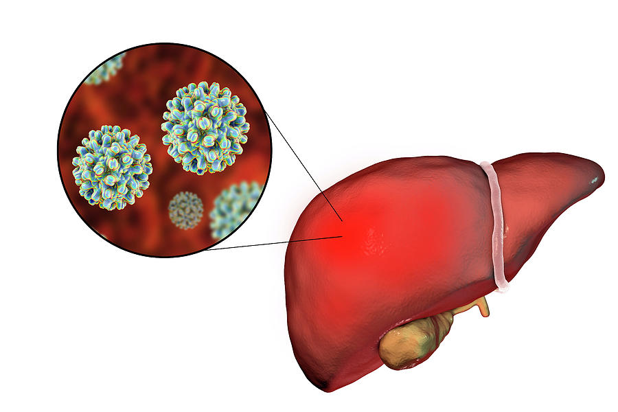 Hepatitis B Photograph By Kateryna Kon/science Photo Library - Fine Art ...