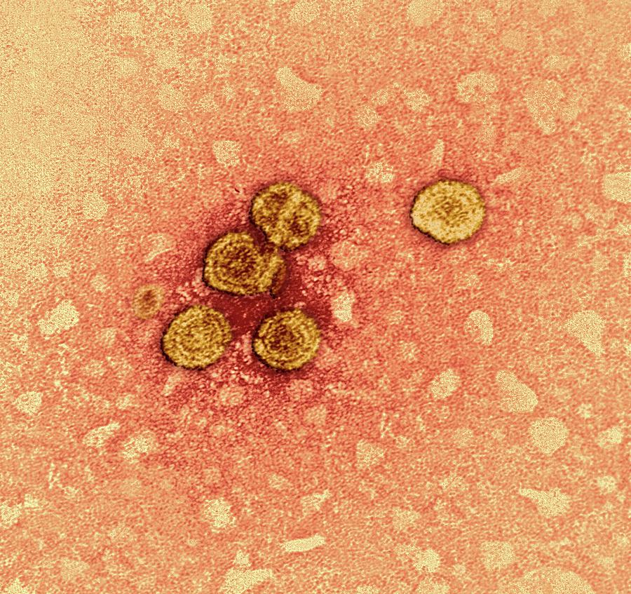 Hepatitis B Virus Particles Photograph by Ami Images/dr. Erskine Palmer ...