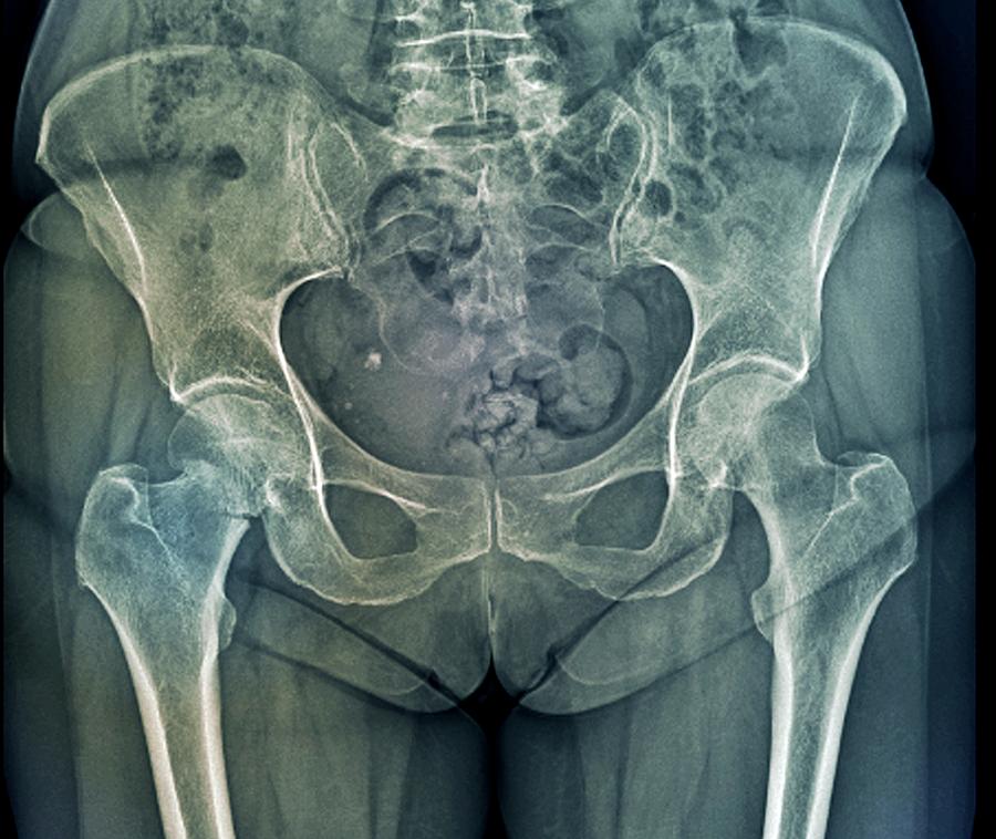 Fracture Photograph - Hip Fracture #1 by Zephyr/science Photo Library