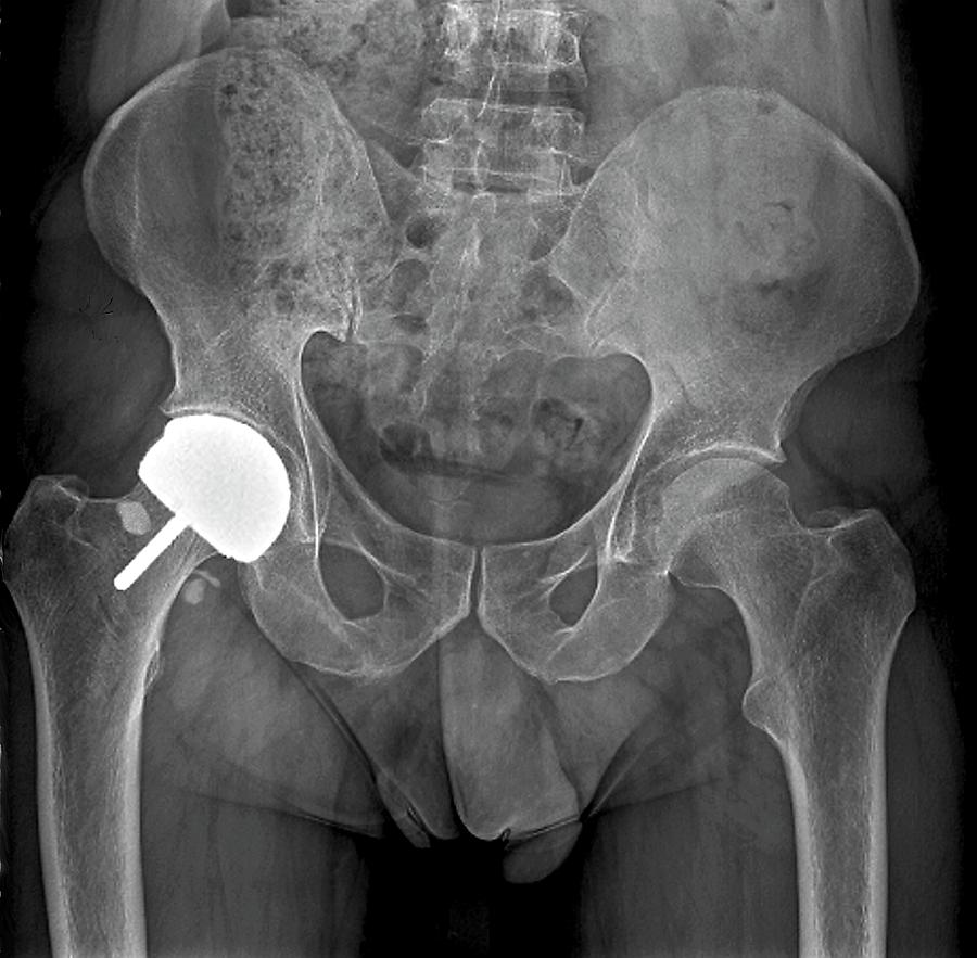 Hip Joint Resurfacing #1 by Zephyr/science Photo Library