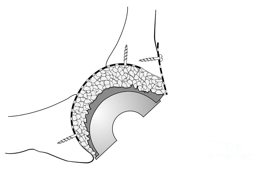 Hip Socket Bone Grafting, Diagram Photograph by D & L Graphics