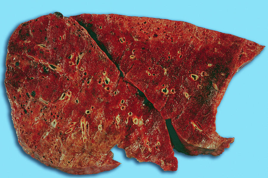 Lung 1 Photograph by Medimage/science Photo Library Pixels