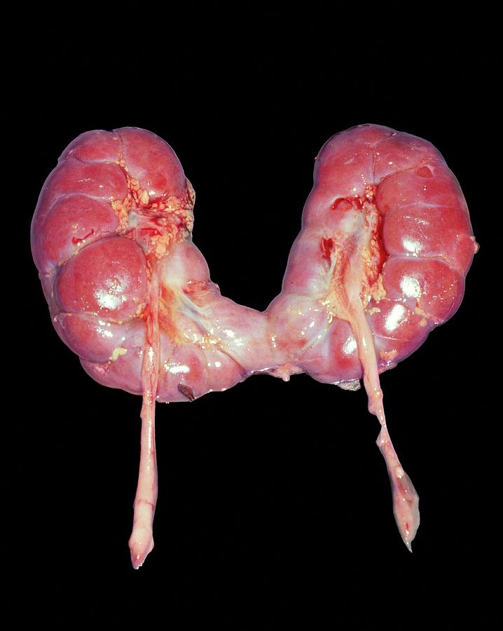 Horseshoe Kidney Photograph - Horseshoe Kidney #1 by Medimage/science Photo Library
