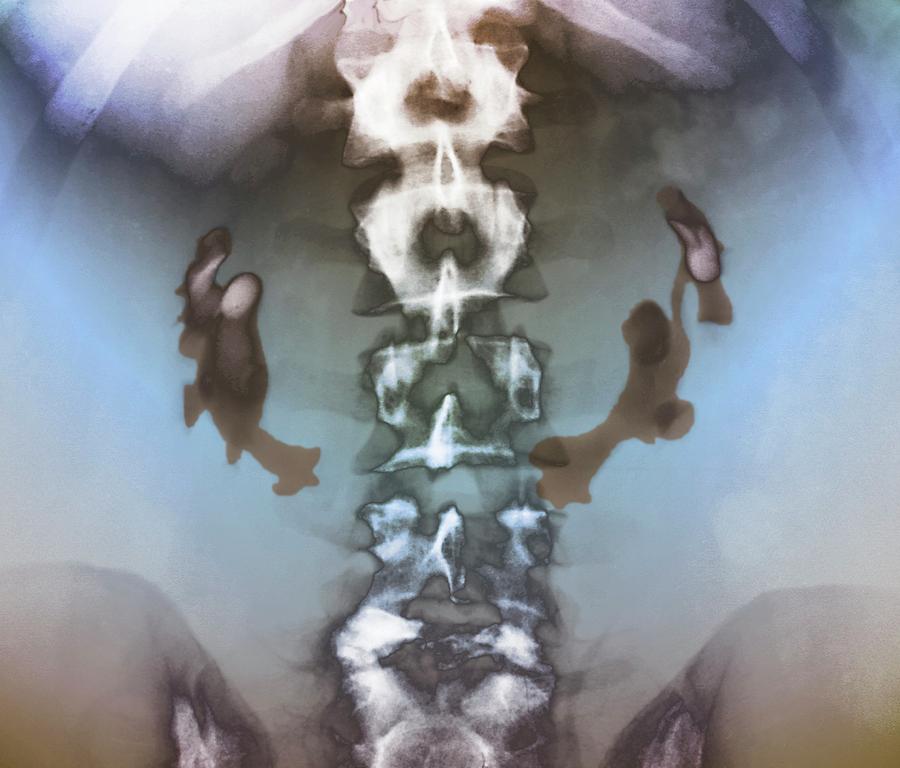 Horseshoe Kidneys 1 Photograph by Zephyr/science Photo Library Pixels