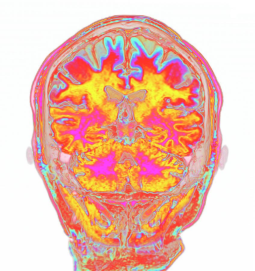 Human Head And Brain #1 Photograph by K H Fung/science Photo Library