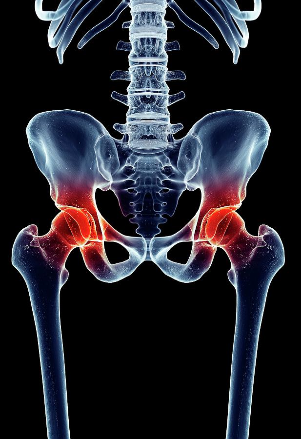 Human Hip Joint Pain Photograph by Sebastian Kaulitzki/science Photo