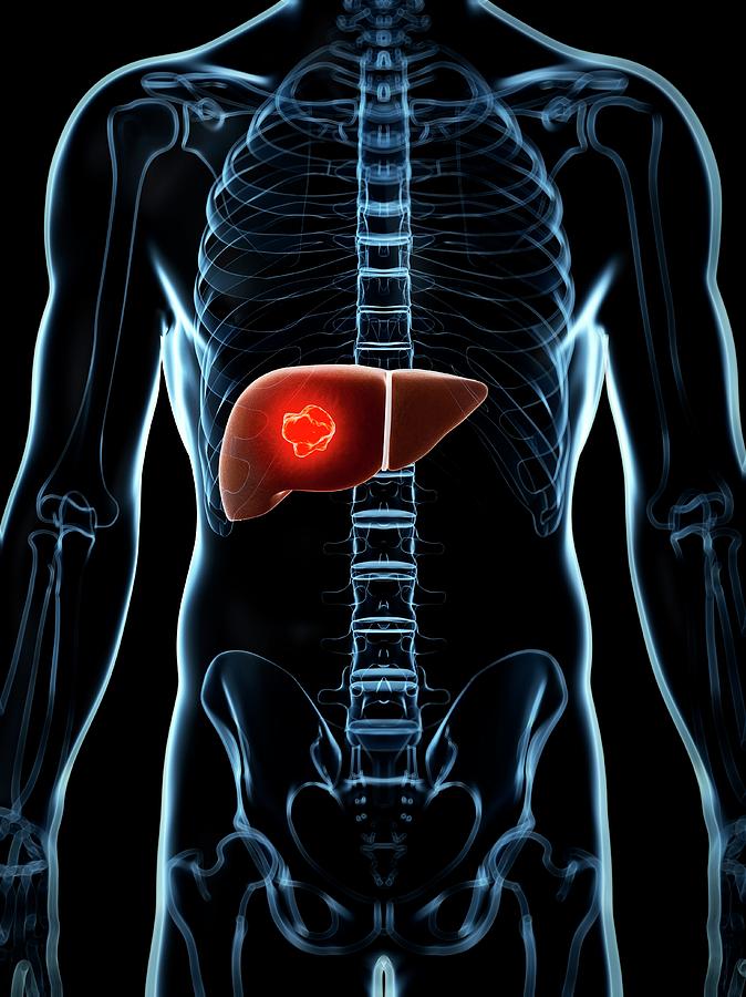 Human Liver Cancer Photograph By Sebastian Kaulitzki - Fine Art America