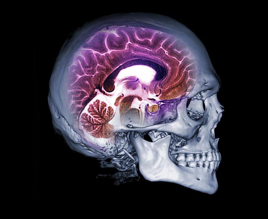 Human Skull And Brain Photograph by Zephyr/science Photo Library - Pixels