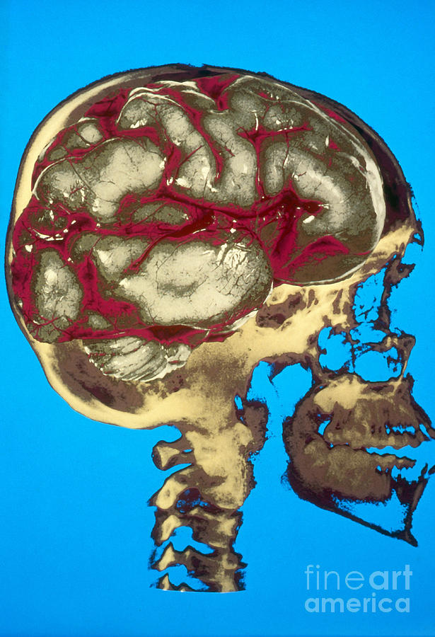 Human Skull X-ray With Digitized Brain #1 Photograph by Bill Longcore