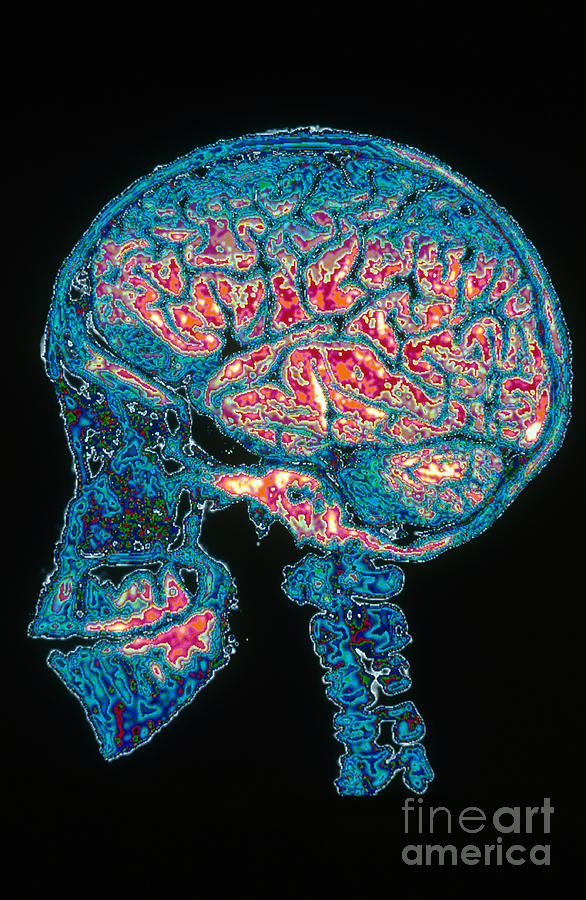 Human Skull X-ray With Digitized Brain #1 Photograph by Scott Camazine