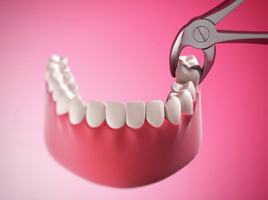 Human Tooth Being Removed #1 Photograph by Sebastian Kaulitzki