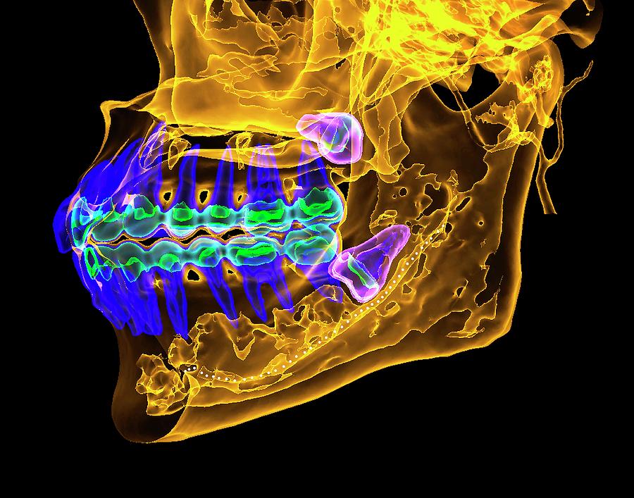 Impacted Molar Teeth #1 Photograph by K H Fung/science Photo Library