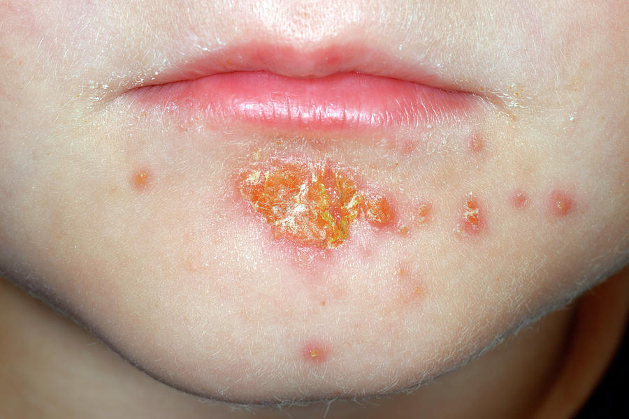 Impetigo Photograph by Dr P. Marazzi/science Photo Library