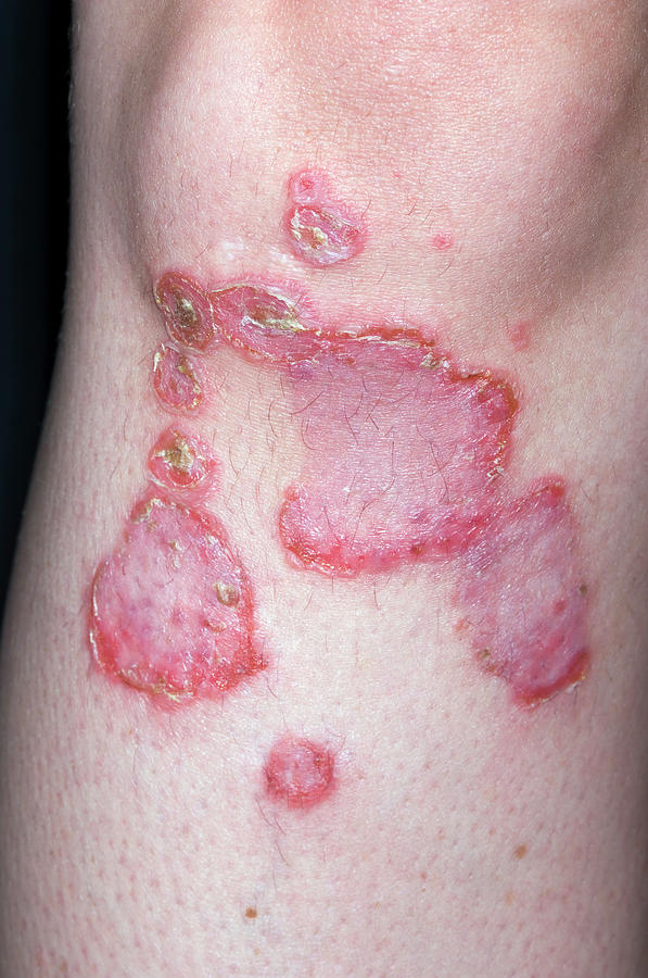 Impetigo Rash Photograph By Dr P. Marazzi Science Photo Library