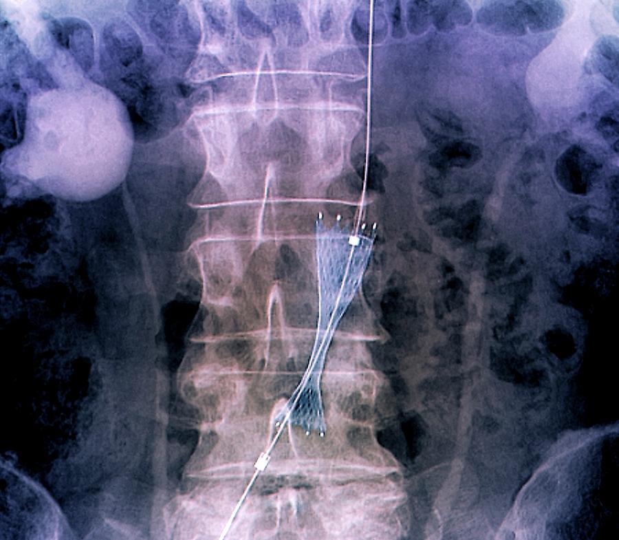 Implantation Of Stent In Aorta Photograph by Zephyr/science Photo ...