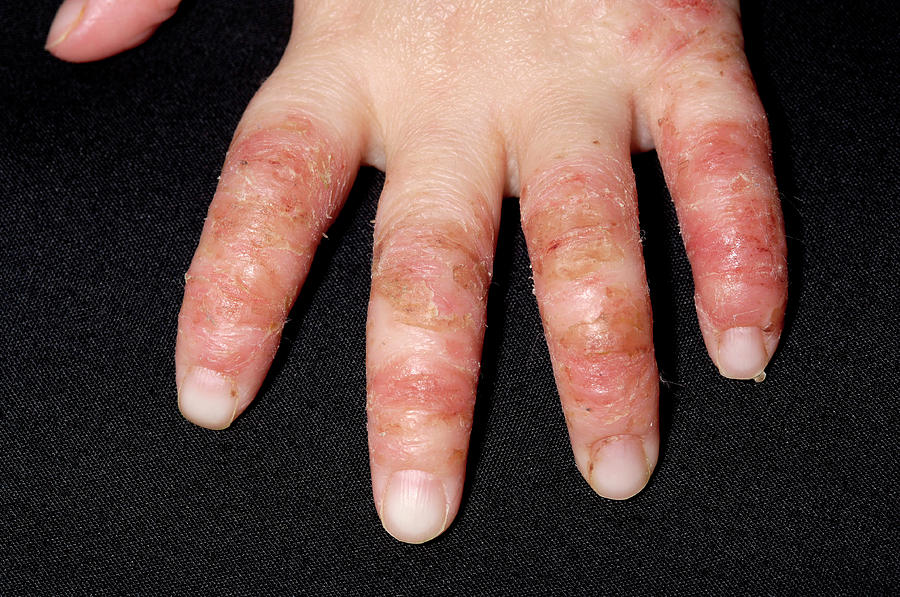 Infected Eczema Photograph By Dr P Marazzi Science Photo Library