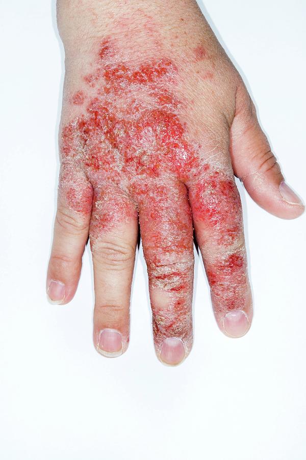Infected Eczema Of The Hand Photograph By Dr P Marazziscience Photo