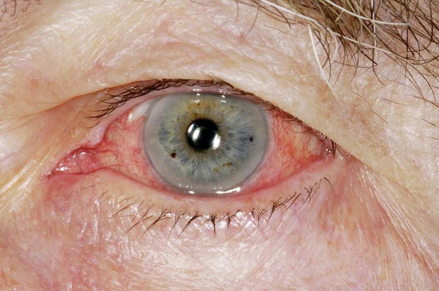 Inflamed Iris Photograph by Dr P. Marazzi/science Photo Library