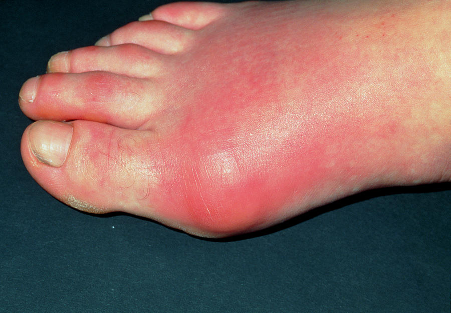 Inflamed Toe Joint In Patient With Gout Photograph By Dr P Marazzi Science Photo Library