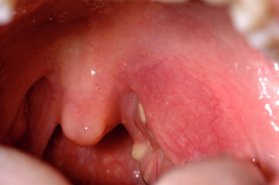 inflamed-tonsil-photograph-by-dr-p-marazzi-science-photo-library