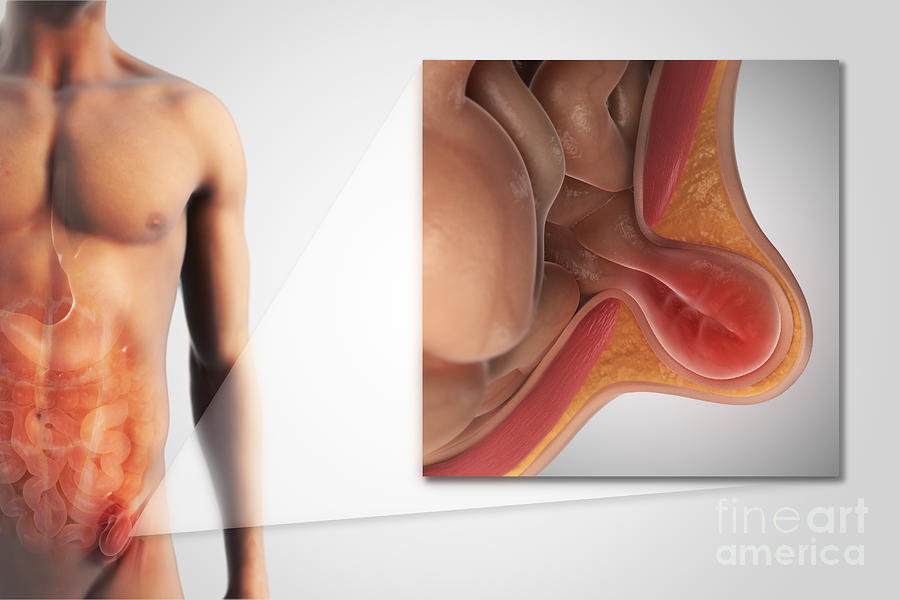 3d Model Photograph - Inguinal Hernia #1 by Science Picture Co